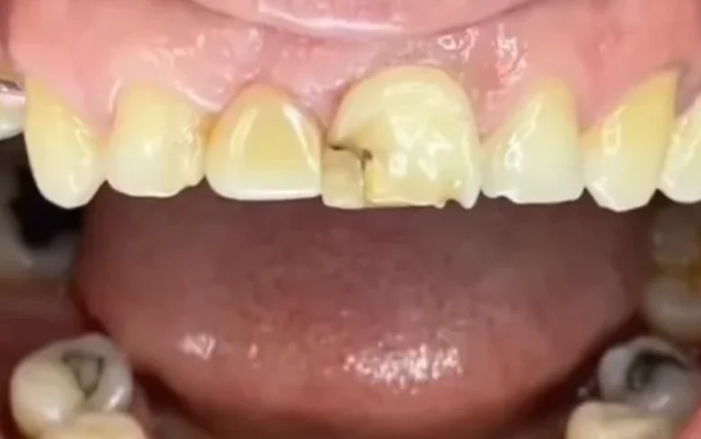 Antes: dientes desgastados y restauraciones antiguas