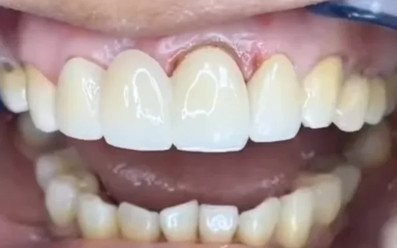 Después: nueva sonrisa en porcelana