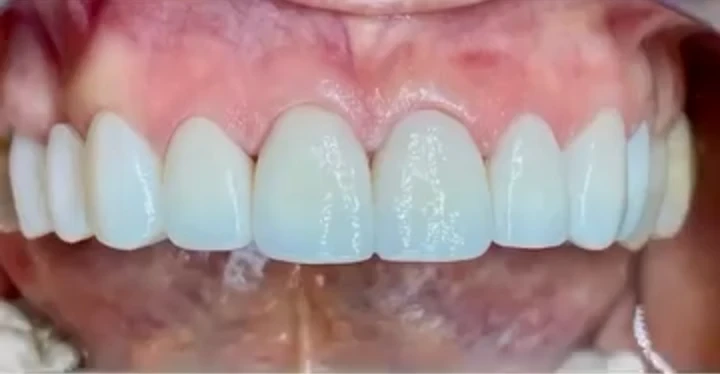 Después: coronas y puente en zirconia