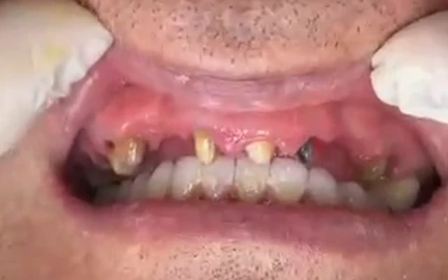 Antes: dientes muy deteriorados y piezas ausentes