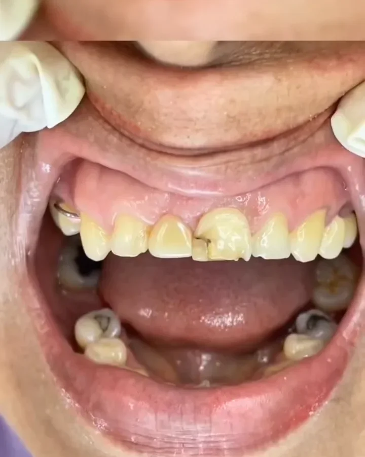 Sonrisa de un paciente antes del tratamiento