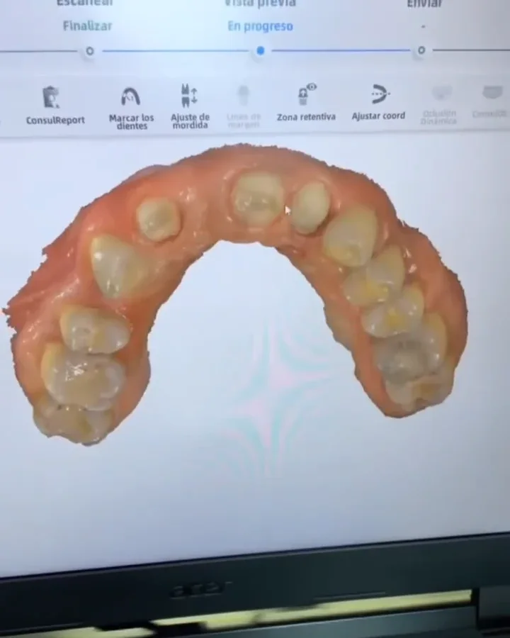 Modelo digital 3D de la sonrisa en la pantalla de planificación