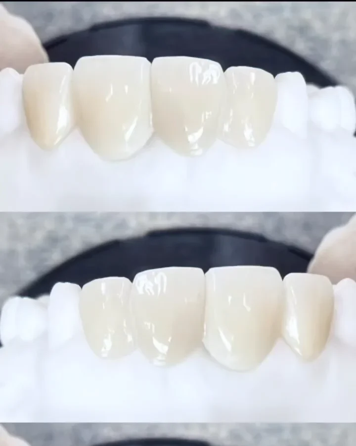 Porcelanas terminadas sobre el modelo, listas para colocar