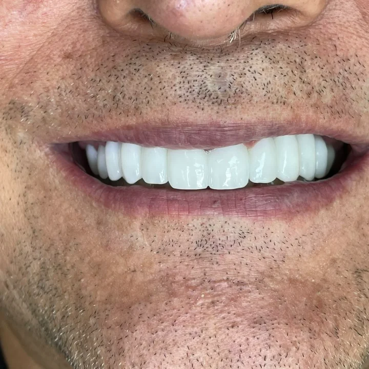 Resultado de frente